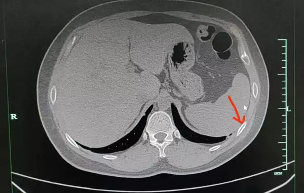 A woman in Ningbo suffered a rib fracture after a positive new crown, and doctors considered it to be caused by forceful coughing