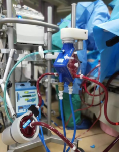 China's domestic extracorporeal membrane pulmonary oxygenation (ECMO) products were approved for marketing